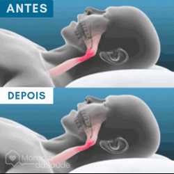 Protetor Bucal Anti-Ronco Znorex®